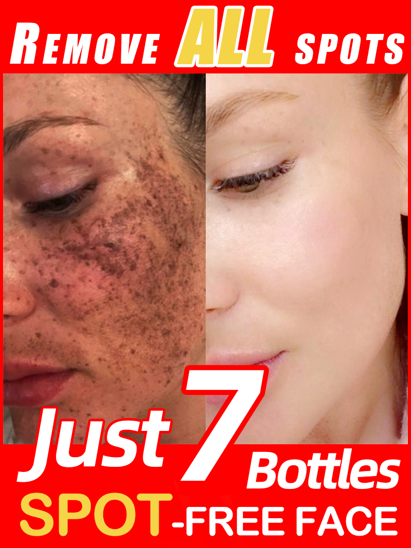 Luxury Skincare Essence - Lighten Freckles Melasma, Facial Dark Spots